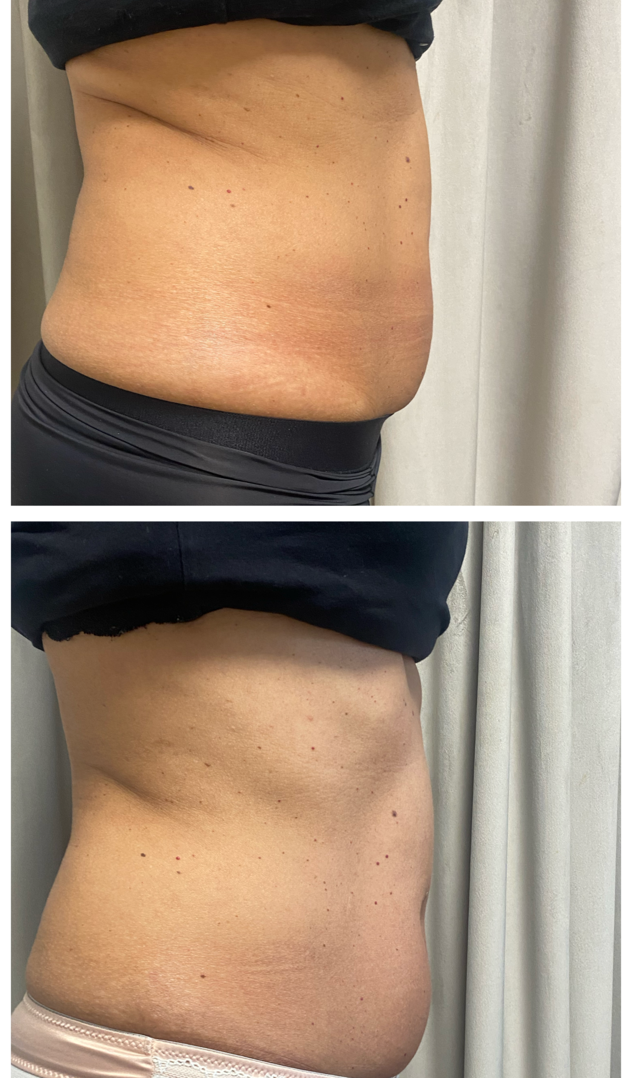 HIEMT kezelés közben