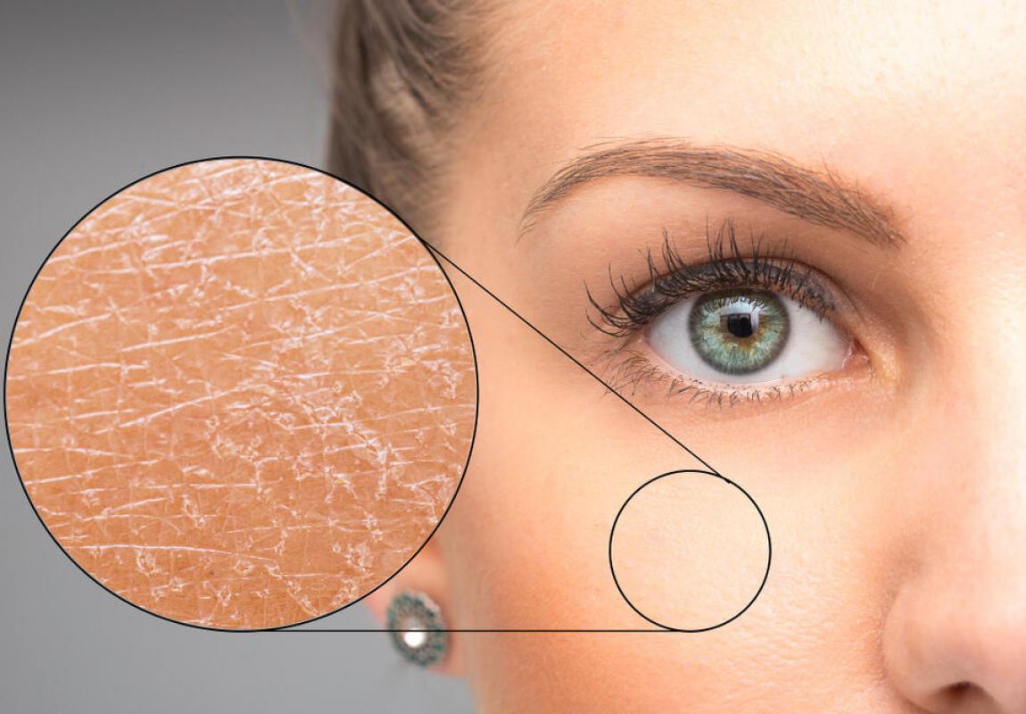 Száraz, érzékeny bőr