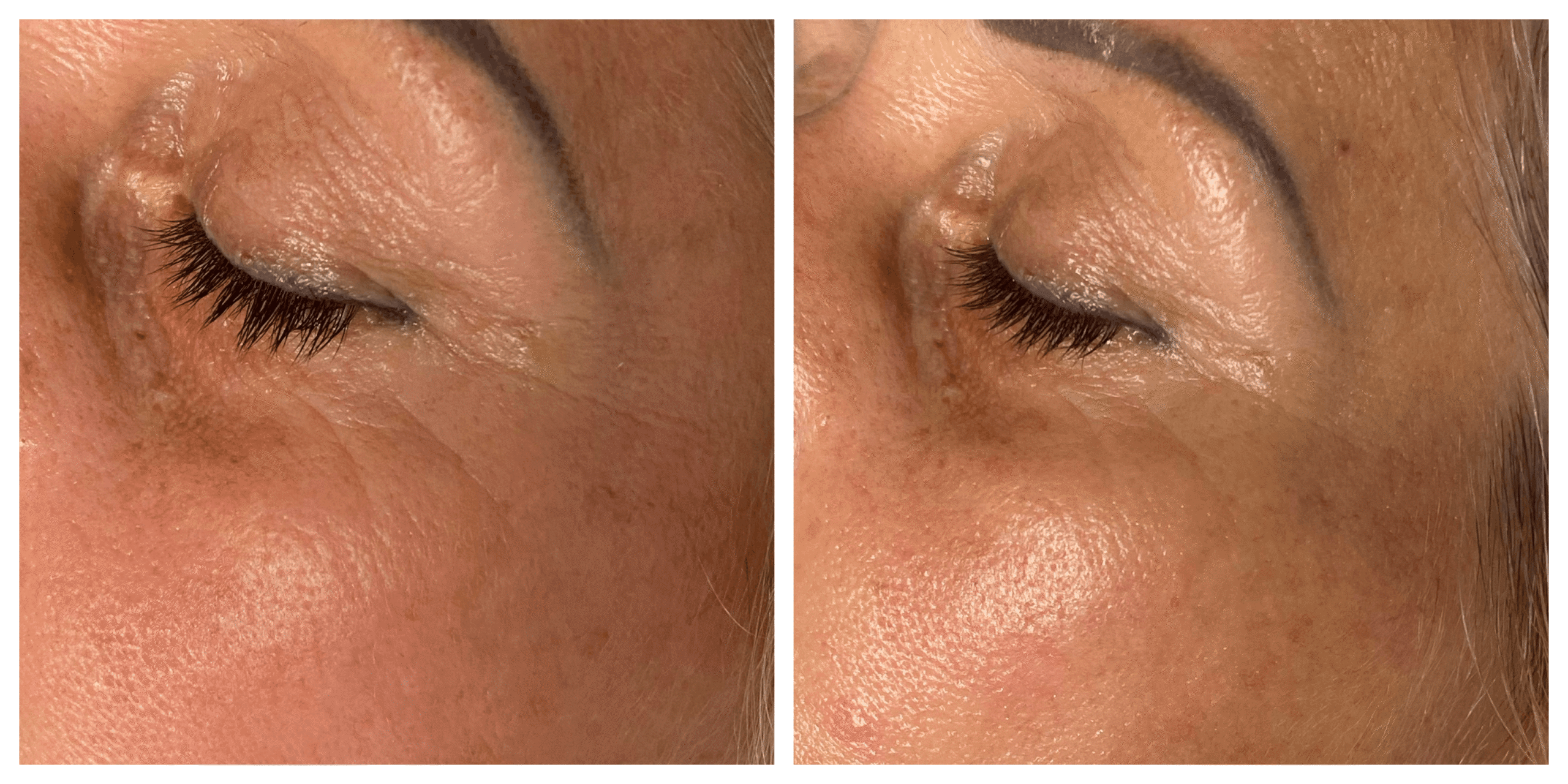 Ráncos bőr eredmény 2