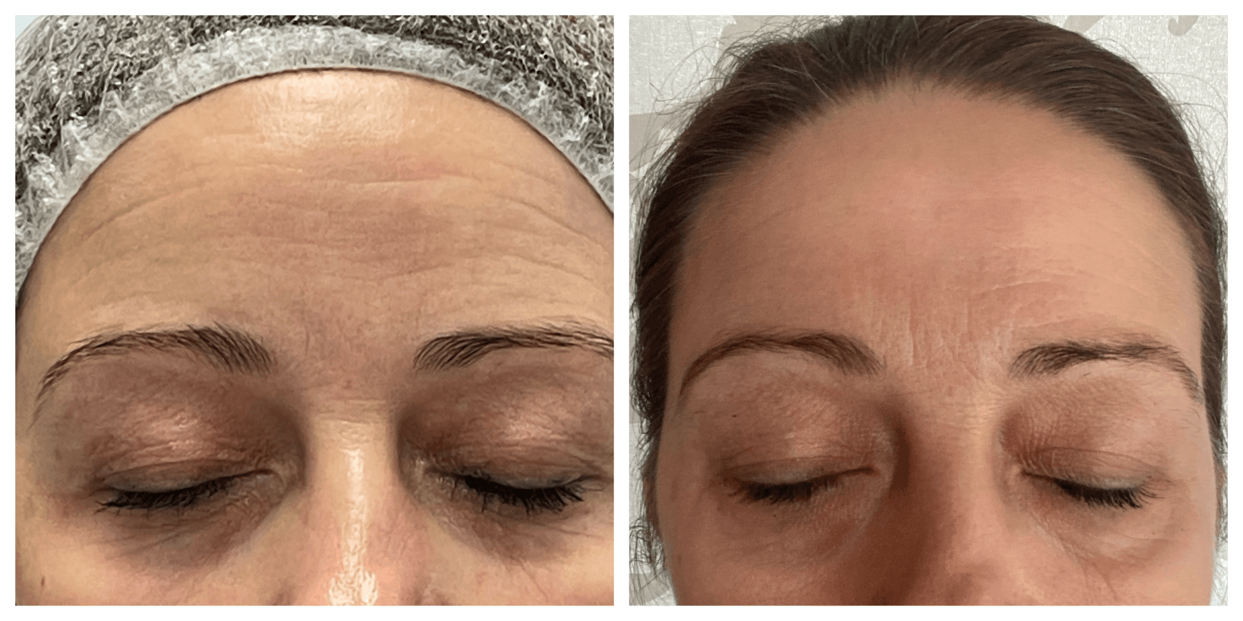 Ráncos bőr eredmény 4